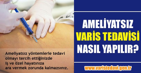 ameliyatsız varis tedavisi