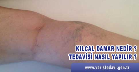 kılcal damar tedavisi