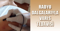 radyo frekans varis tedavisi