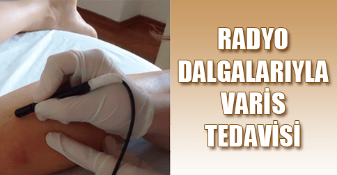 radyo frekans varis tedavisi