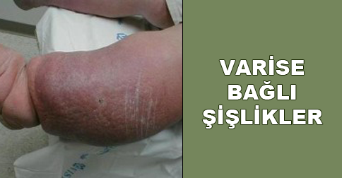 varis-sislikleri