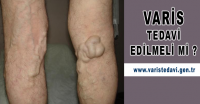 varis tedavi edilmeli mi, edilmezse ne olur