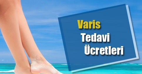 varis tedavi ücretleri